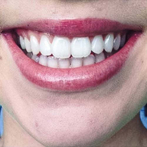 Dental whitening